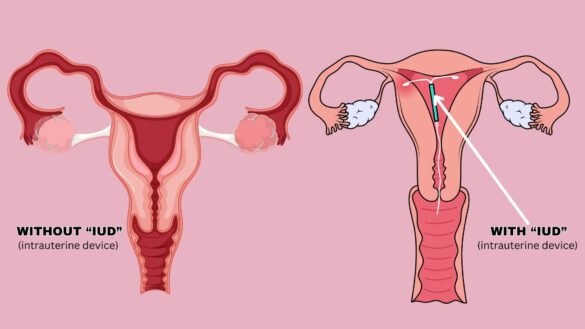 Cycle Syncing With an IUD and without IUD